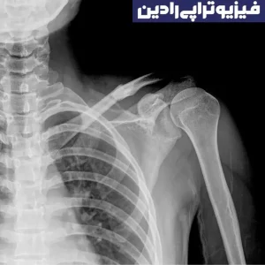 اشعه ایکس برای فیزیوتراپی شانه