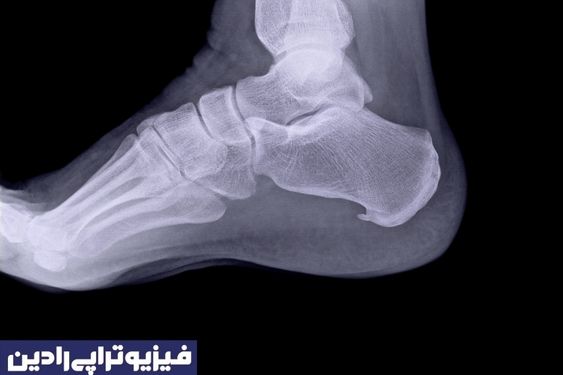 خار پاشنه
