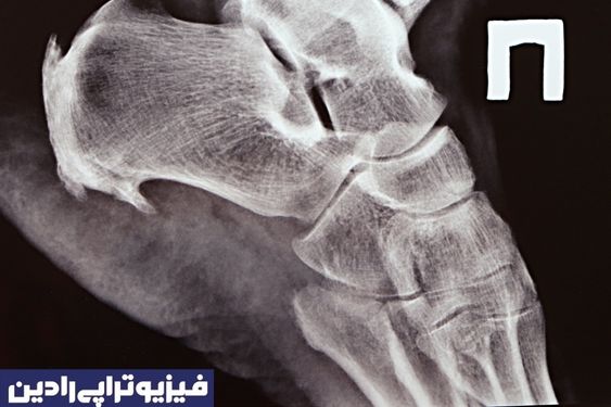 خار پاشنه