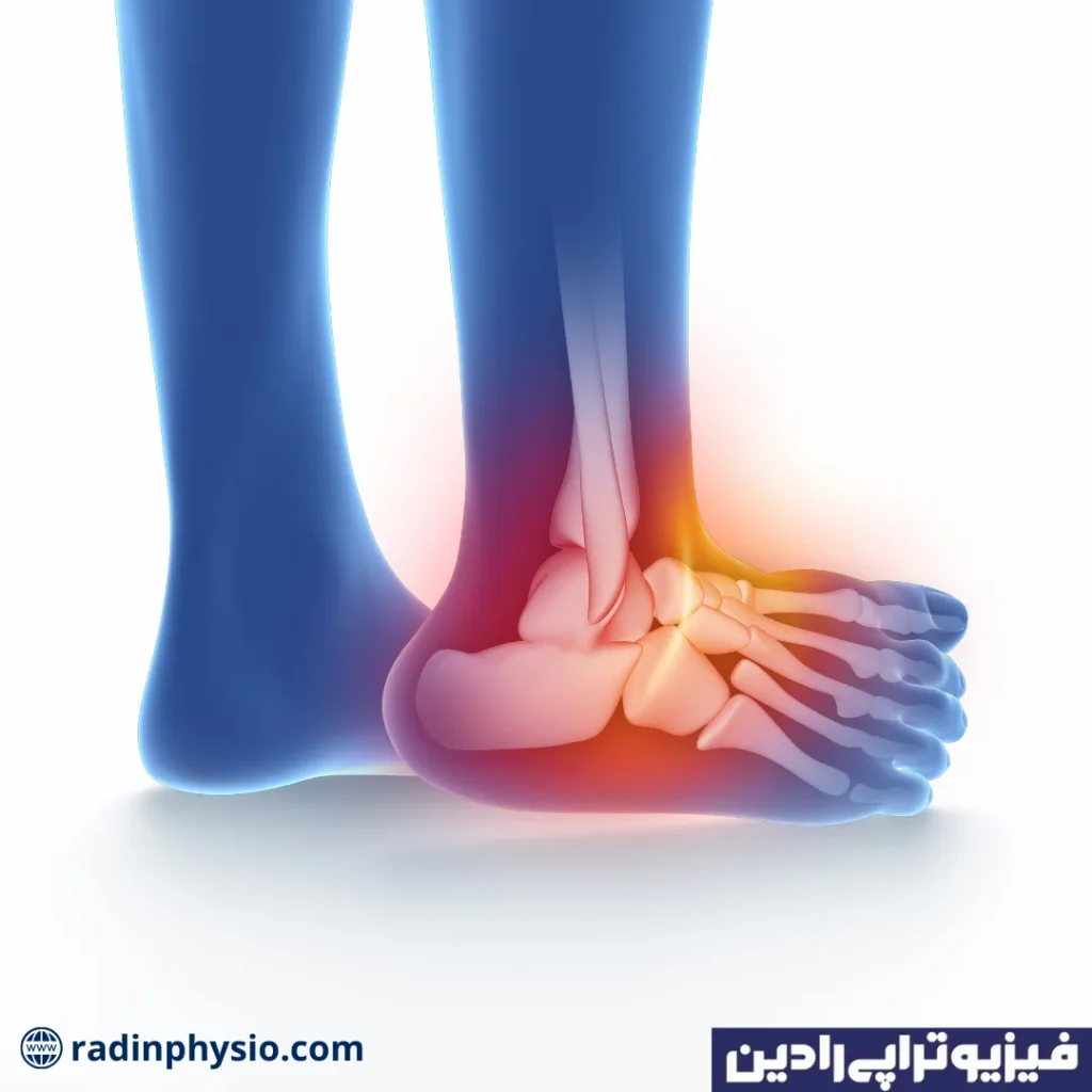 فیزیوتراپی مچ پا