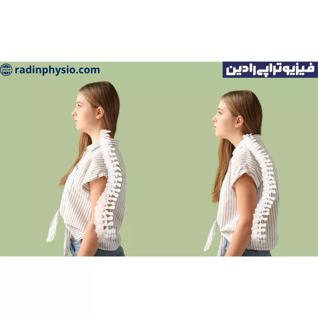انواع قوز کمر