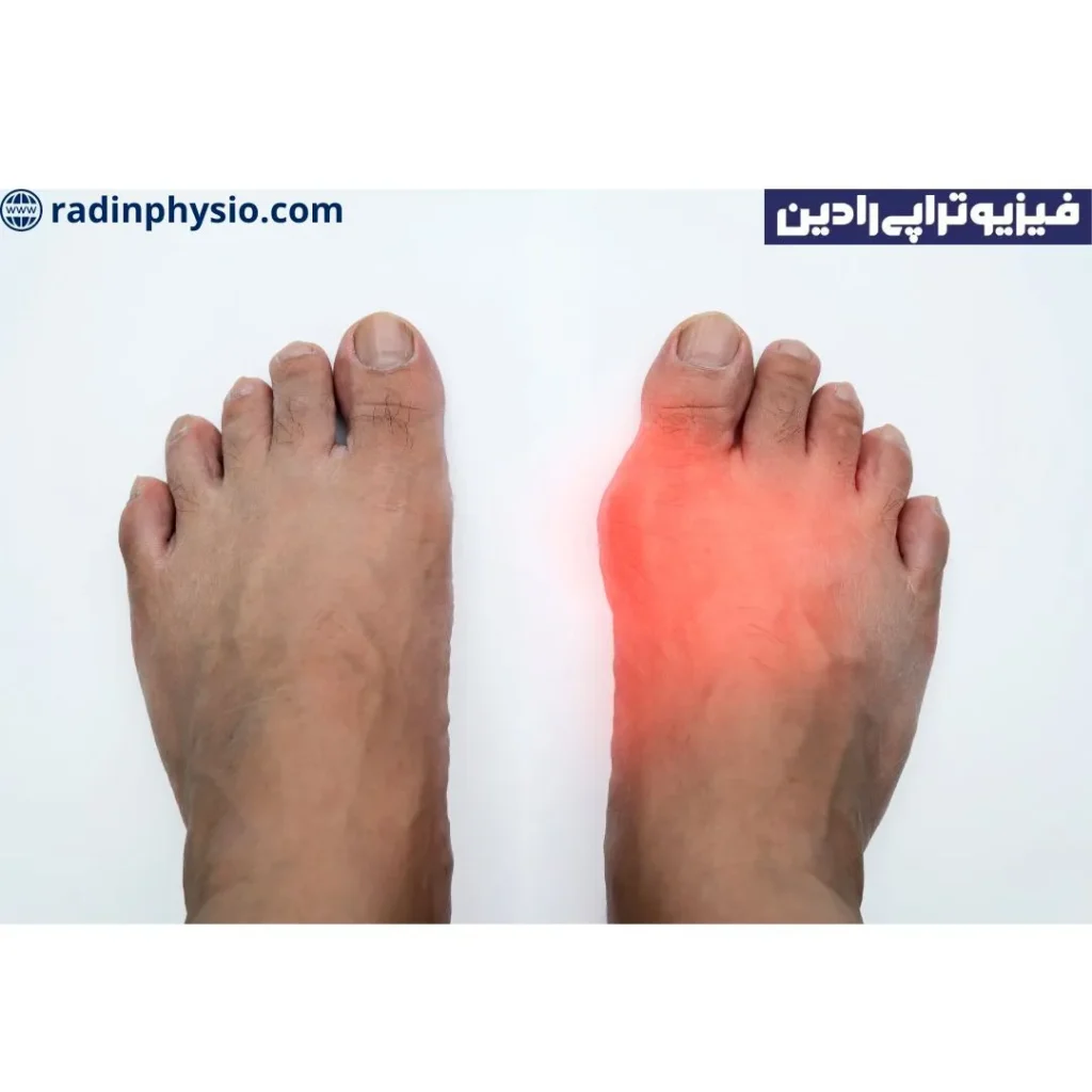 انواع نقرس