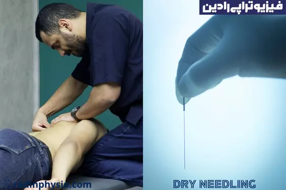 درای نیدلینگ در بهترین فیزیوتراپی شمال تهران