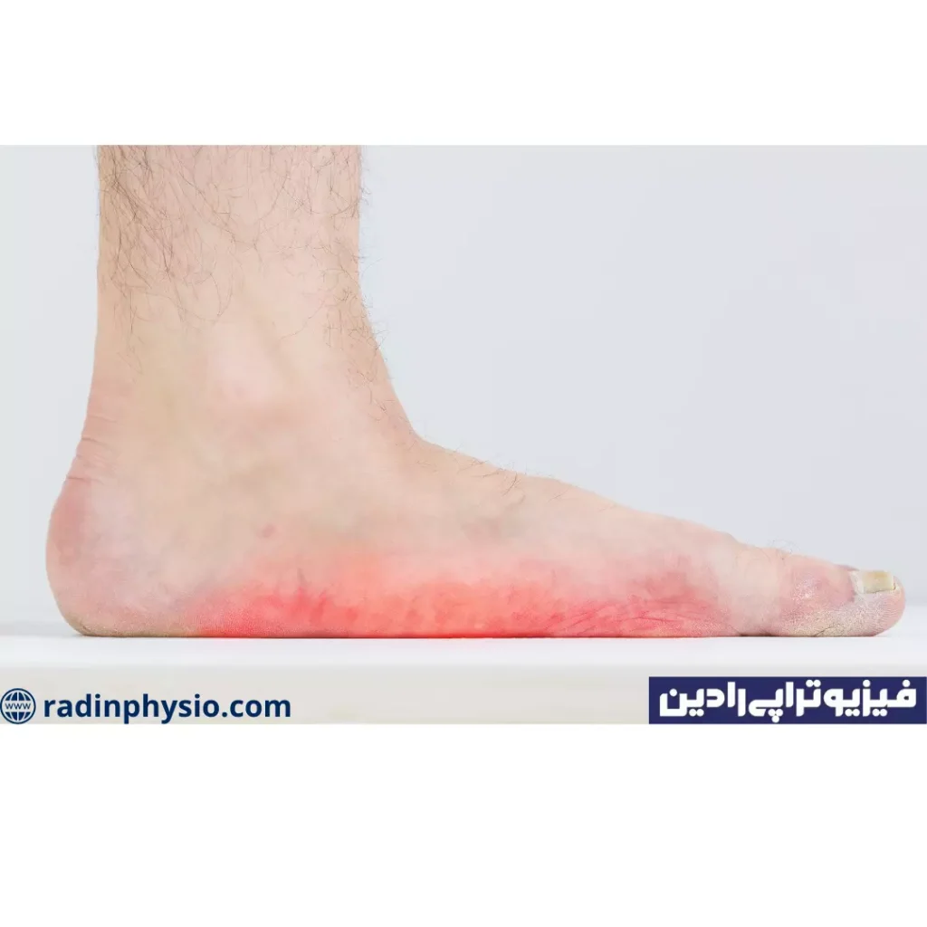 فیزیوتراپی صافی کف پا