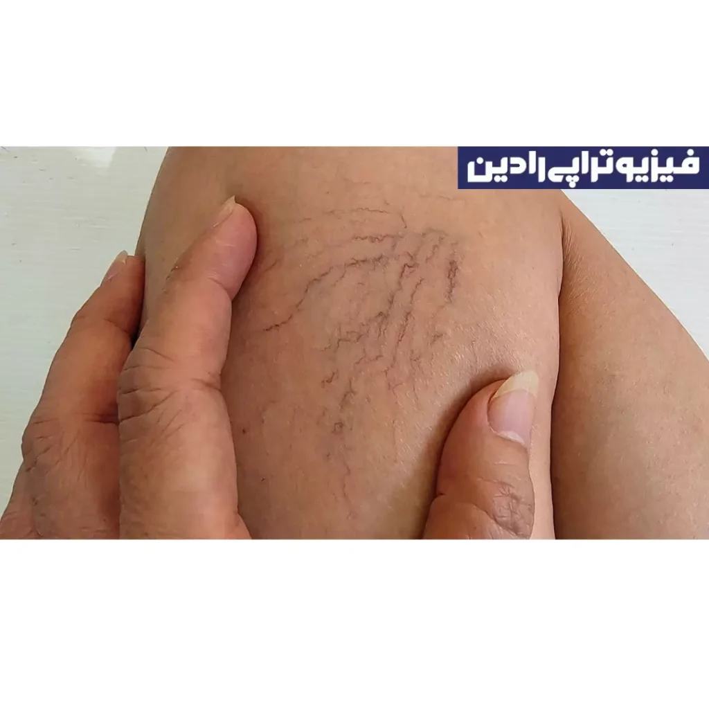 فیزیوتراپی واریس