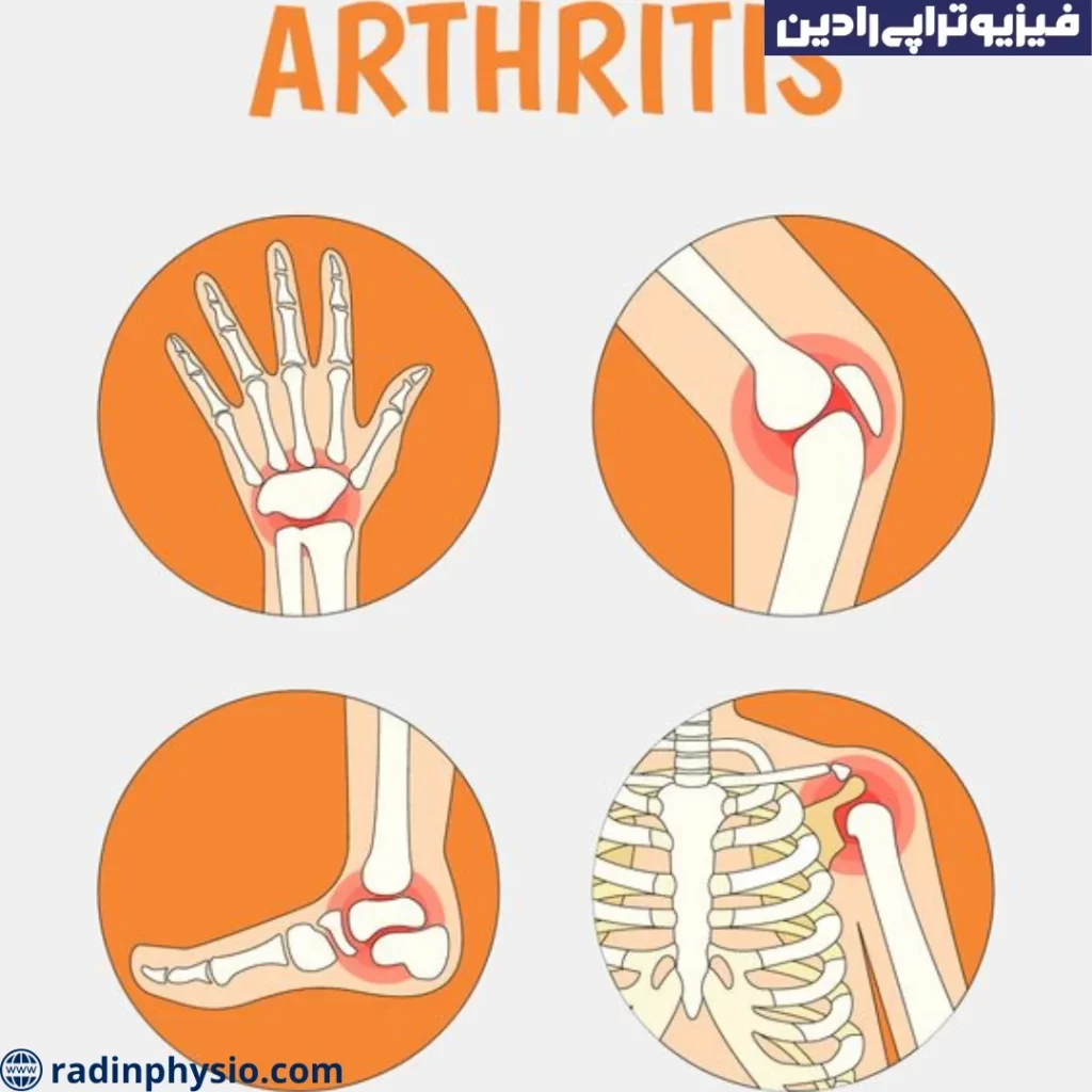 علائم و نشانه های آرتروز
