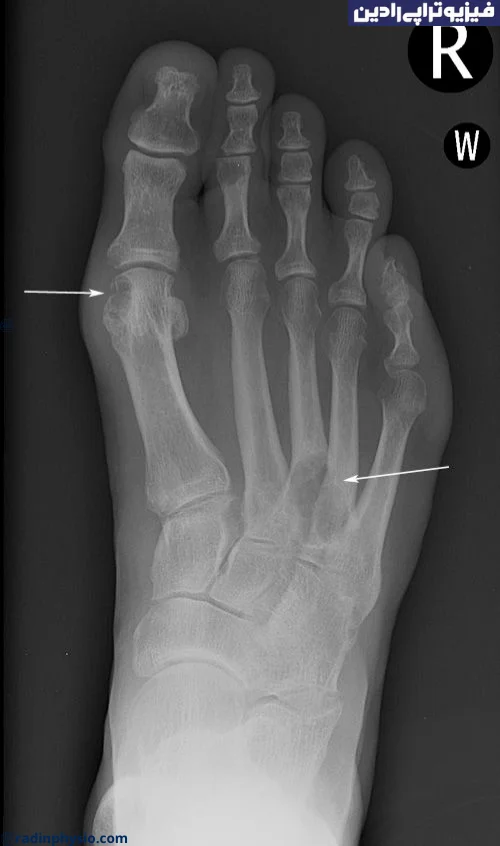آرتروز- نقرس ( gout)
