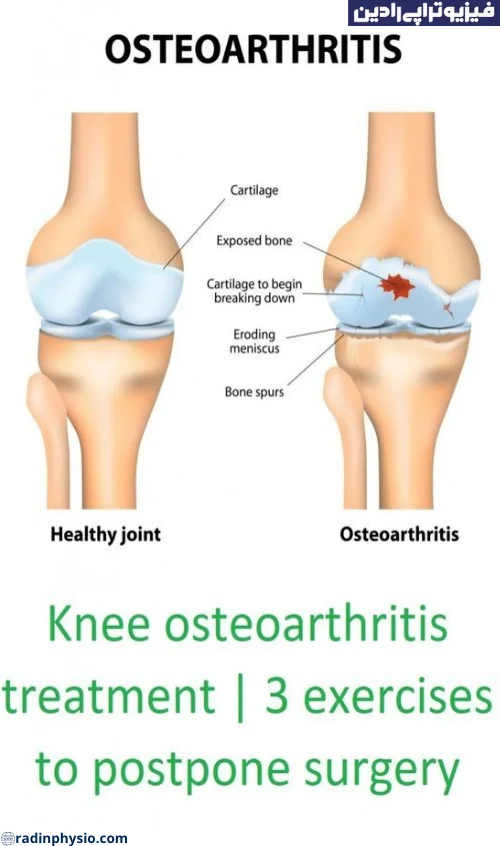 فیزیوتراپی آرتروز(Osteoarthritis) دژنراتیو