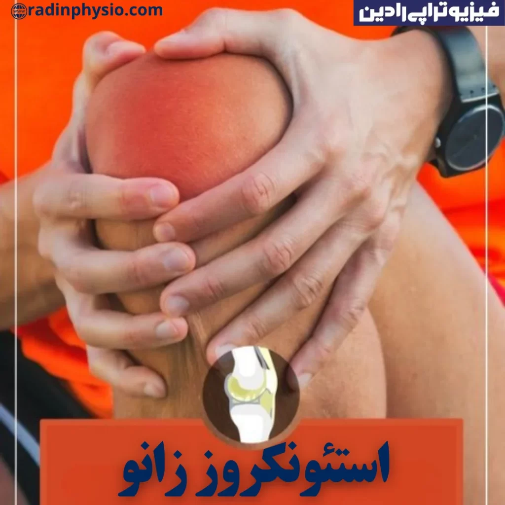 فیزیوتراپی استئونکروز زانو یا نکروز آواسکولار زانو