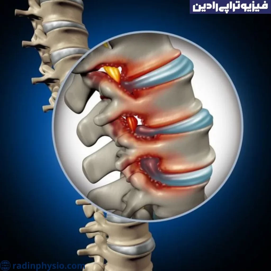 تنگی کانال نخاعی گردنی(Cervical spinal stenosis)