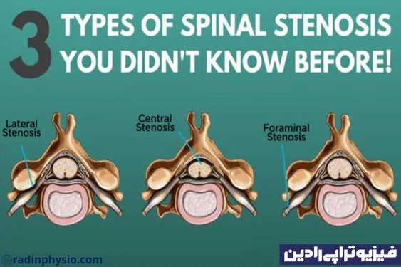 تنگی کانال نخاعی کمری (Lumbar spinal stenosis)