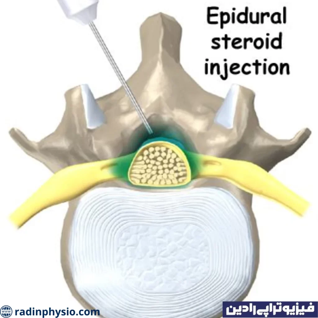 فیزیوتراپی تنگی کانال نخاعی کمری (Lumbar spinal stenosis)