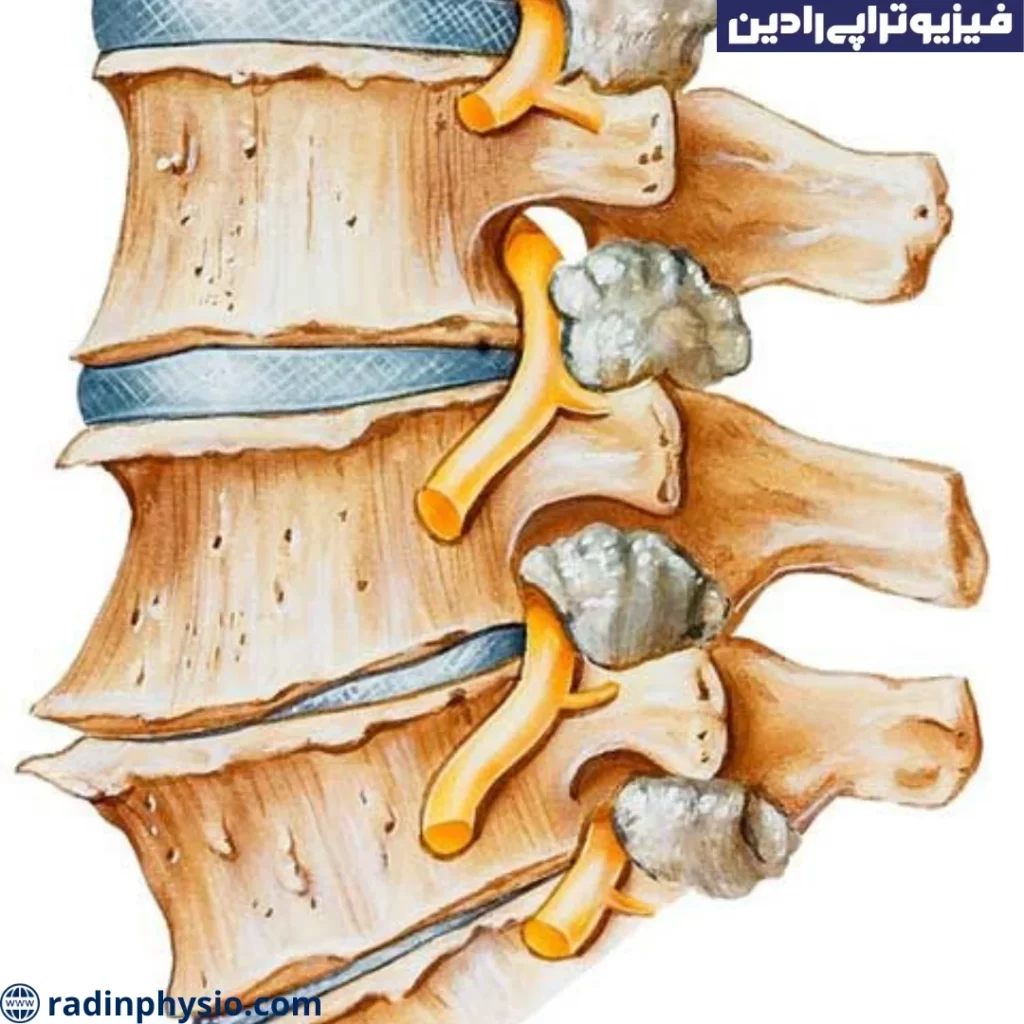 تنگی کانال نخاعی کمری (Lumbar spinal stenosis)