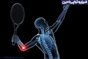 فیزیوتراپی تنیس البو، آرنج تنیس بازان