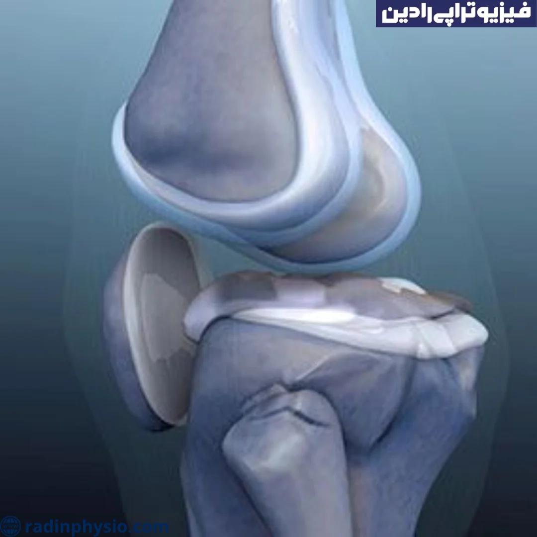 فیزیوتراپی صدای مفاصل یا کریپتوس (Crepitus)
