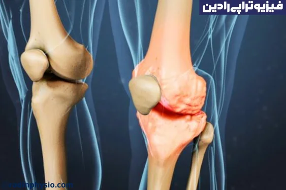 فیزیوتراپی صدای مفاصل یا کریپتوس (Crepitus)