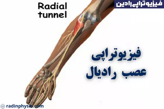 فیزیوتراپی افتادگی مچ دست و عصب رادیال تهران