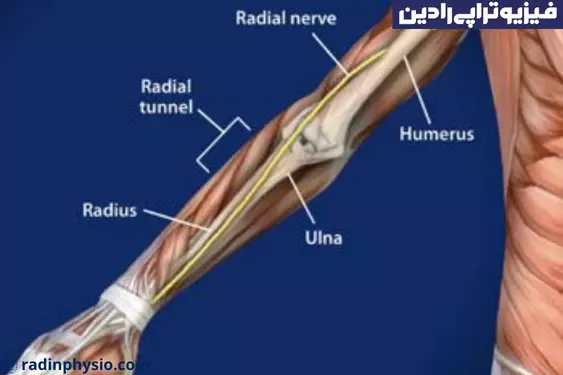 فیزیوتراپی افتادگی مچ دست و عصب رادیال شمال تهران