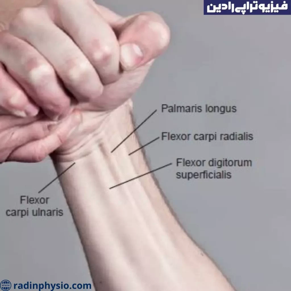 فیزیوتراپی افتادگی مچ دست و عصب رادیال تهران