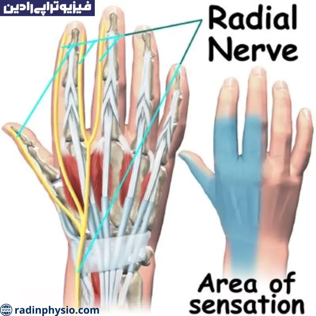 فیزیوتراپی افتادگی مچ دست و عصب رادیال تهران
