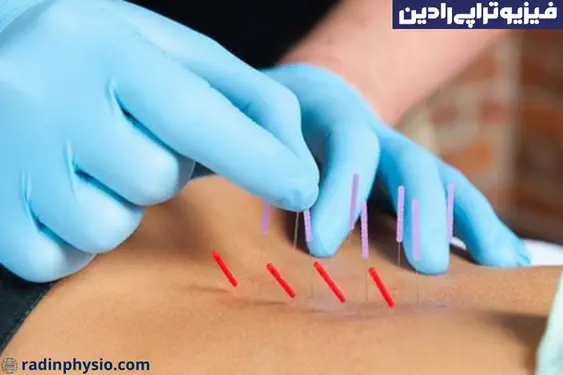 فیزیوتراپی درای نیدلینگ