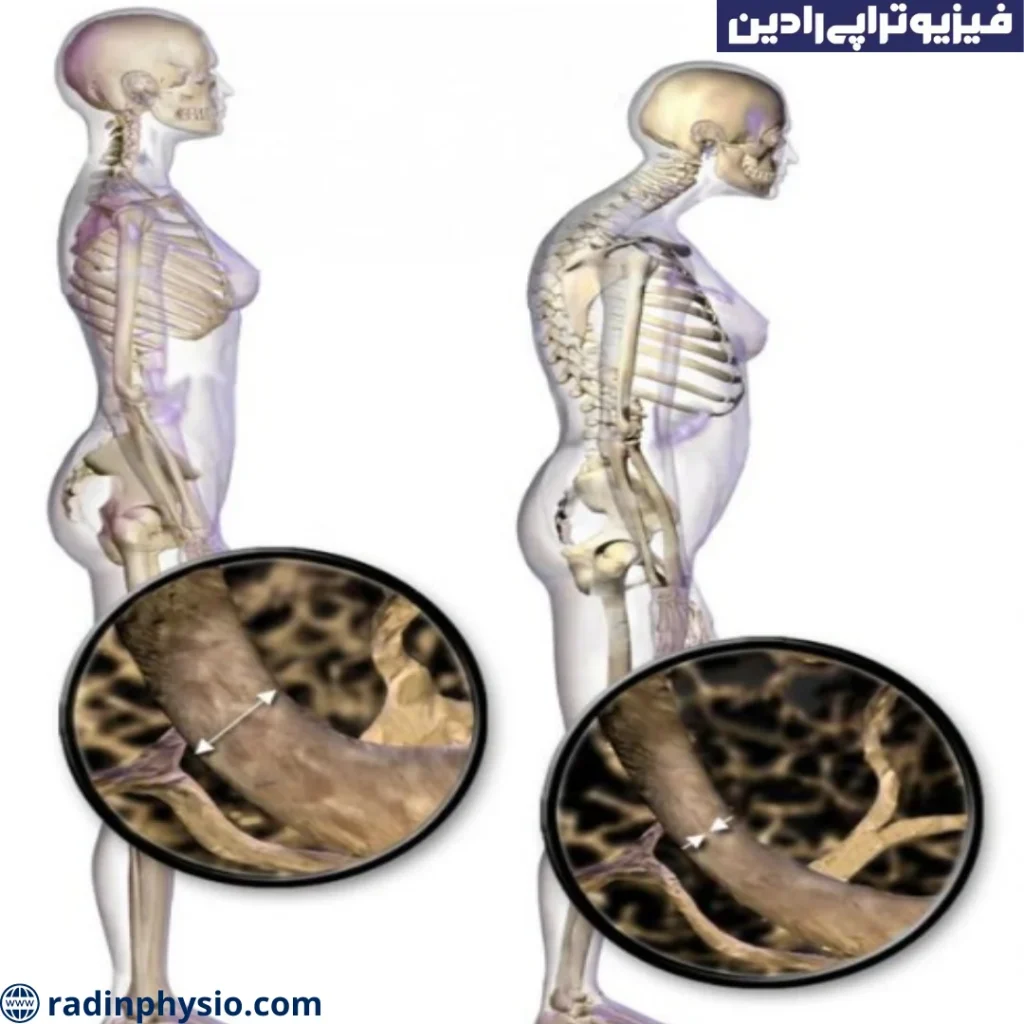 گوژپشتی در نرمی استخوان