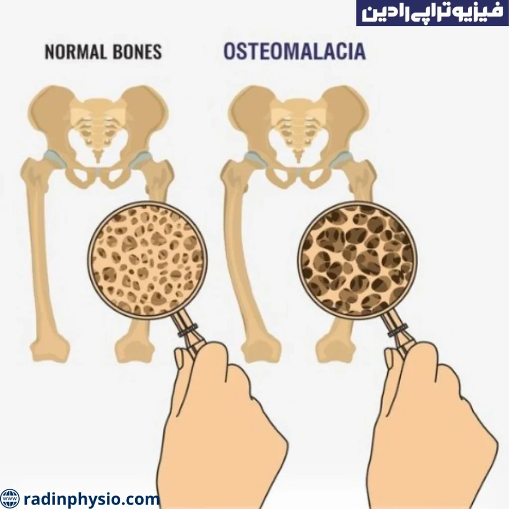 فیزیوتراپی نرمی استخوان