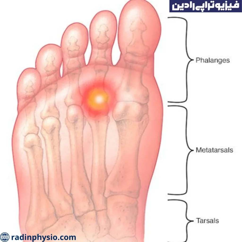 شکستگی حاد کف پا