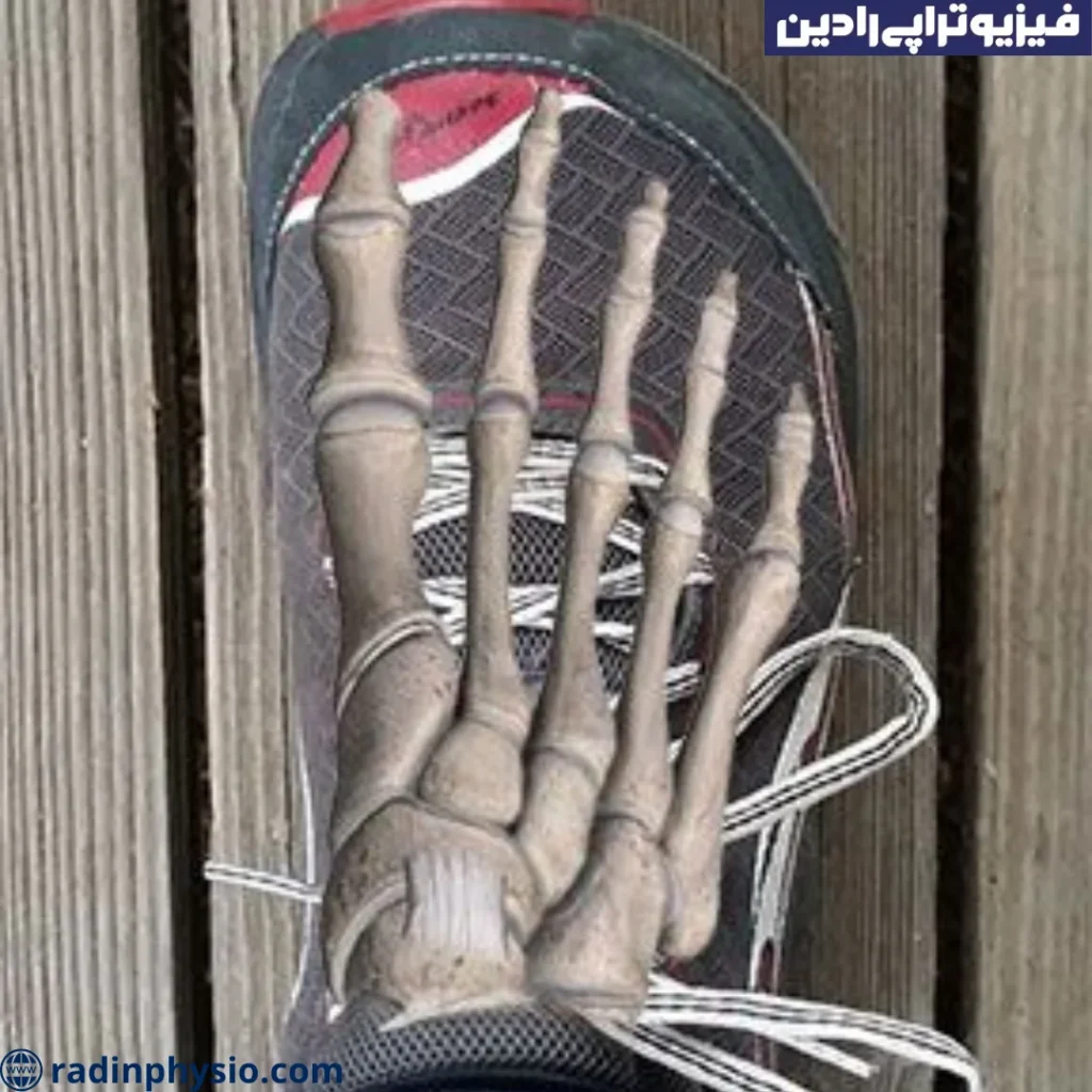 درمان شکستگی کف پا