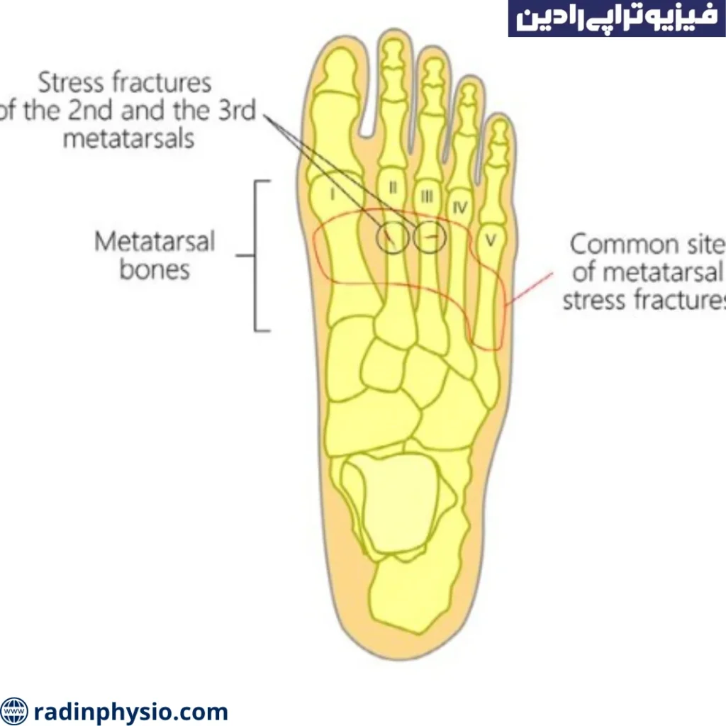فیزیوتراپی شکستکی کف پا