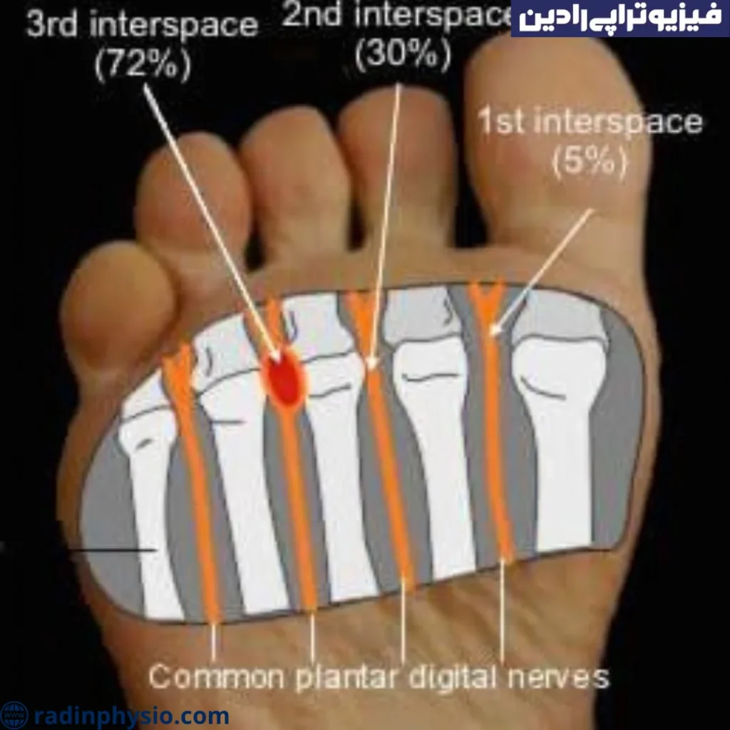 پای مورتون