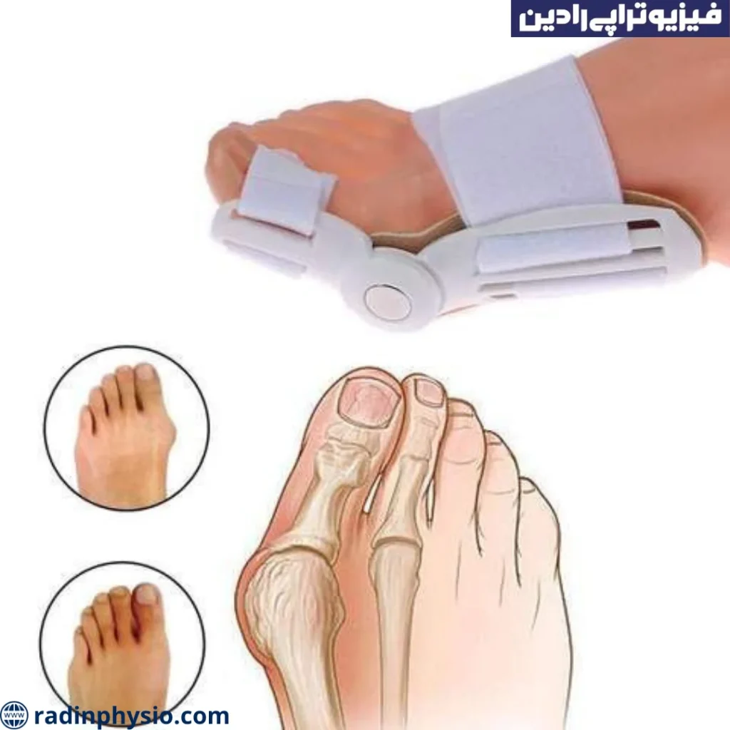 انگشت چنگالی پا فیزیوتراپی انگشت چنگالی پا، ‫بیرون زدگی استخوان شست پا‬‎ (هالوکس ولگوس)​