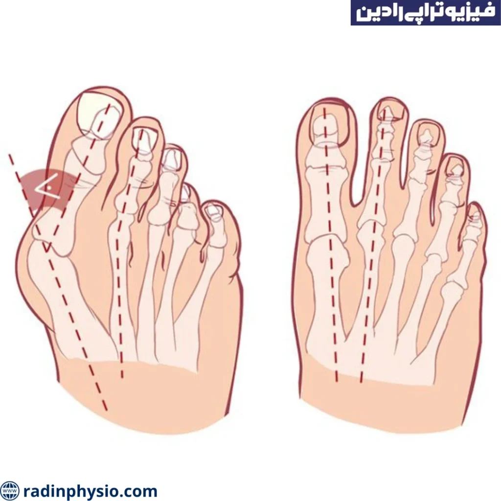 فیزیوتراپی انگشت پا چنگالی