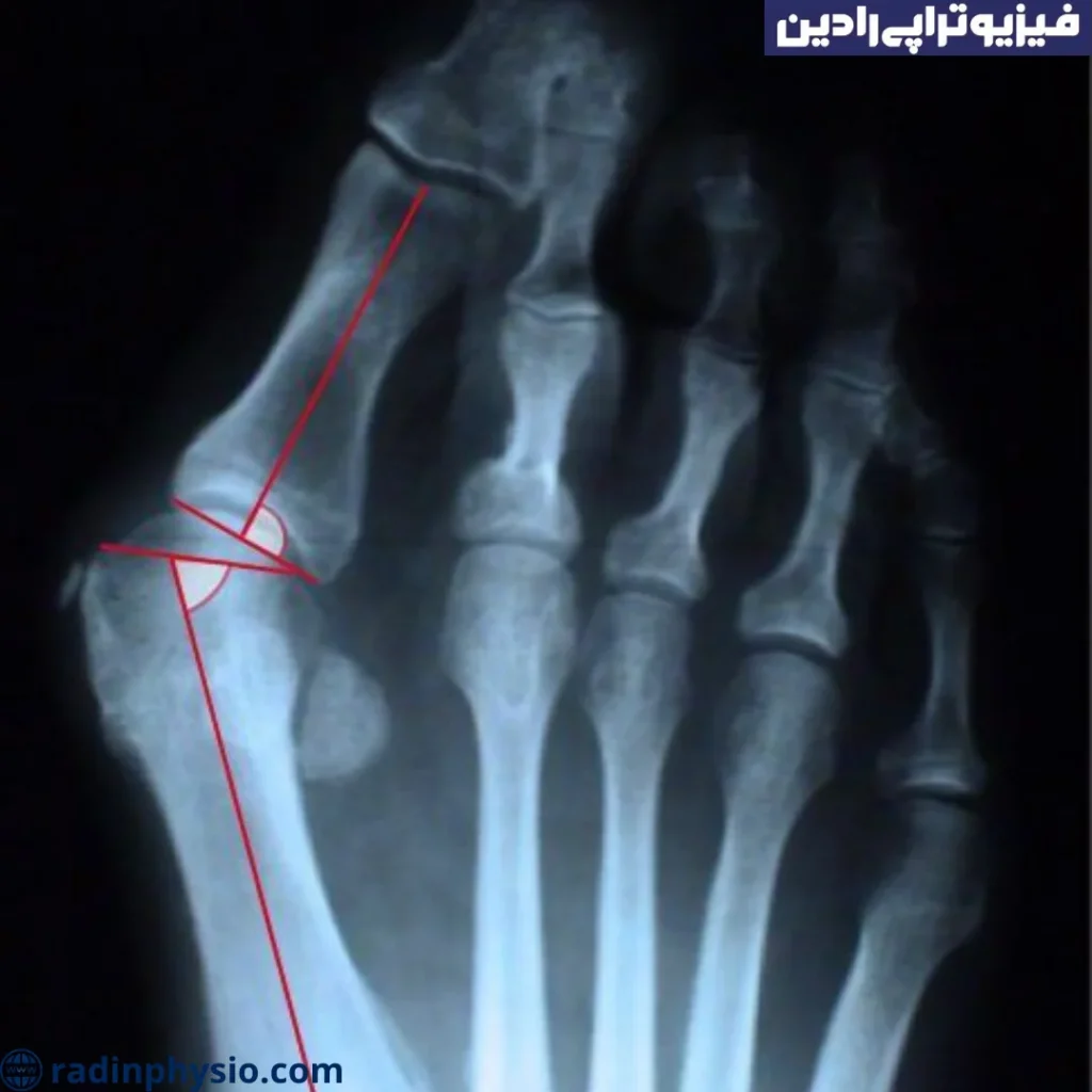 روش تشخیص انگشت چنگالی پا