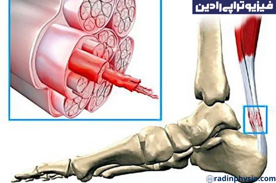 کوتاهی تاندونیت آشیل پا