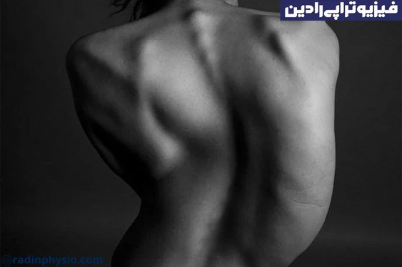 اسکولیوز عضلانی