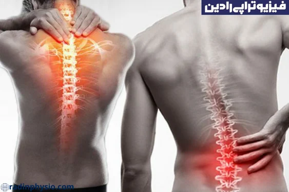 اسکولیوز ثانویه