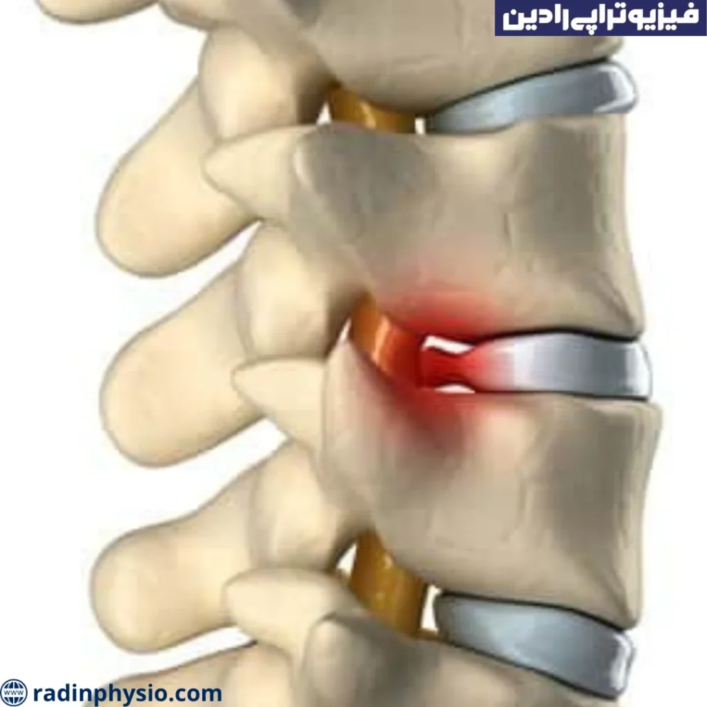 رادیکولوپاتی چیست؟ فیزیوتراپی رادیکولوپاتی