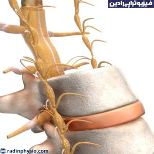 فیزیوتراپی رادیکولوپاتی