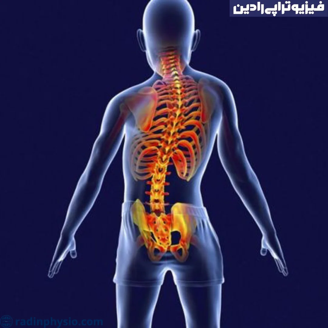 کج پشتی یا اسکولیوز