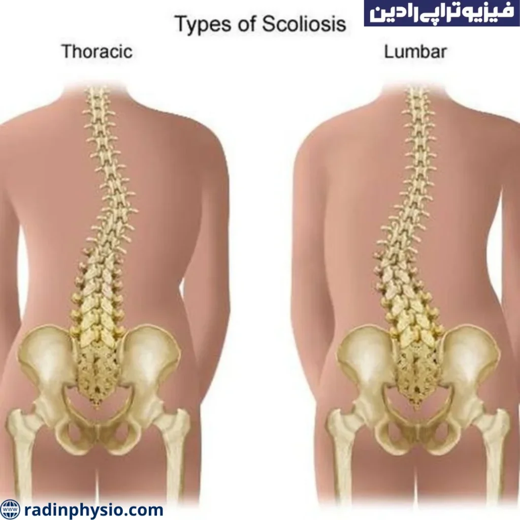 انواع مختلف کج پشتی