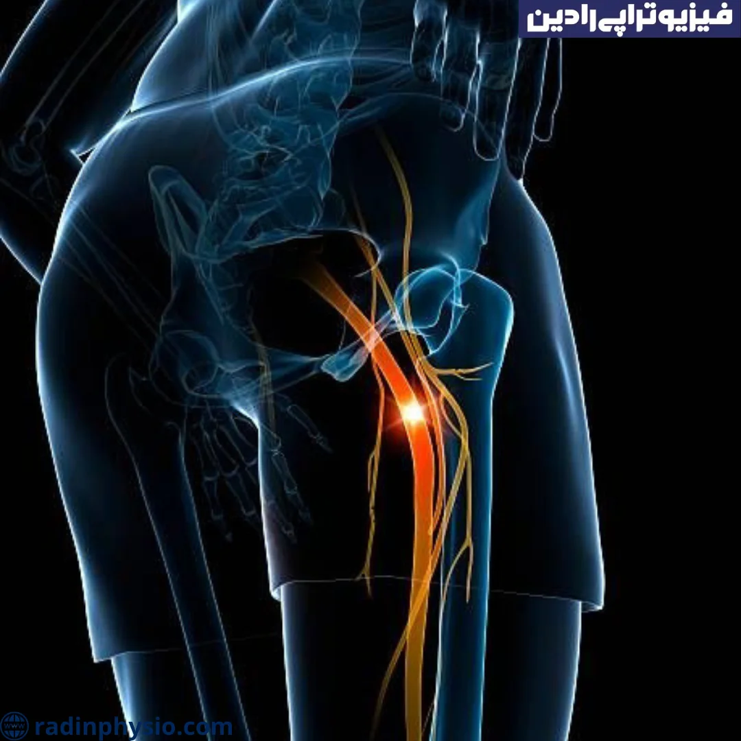 علائم دیسک کمر در پاها