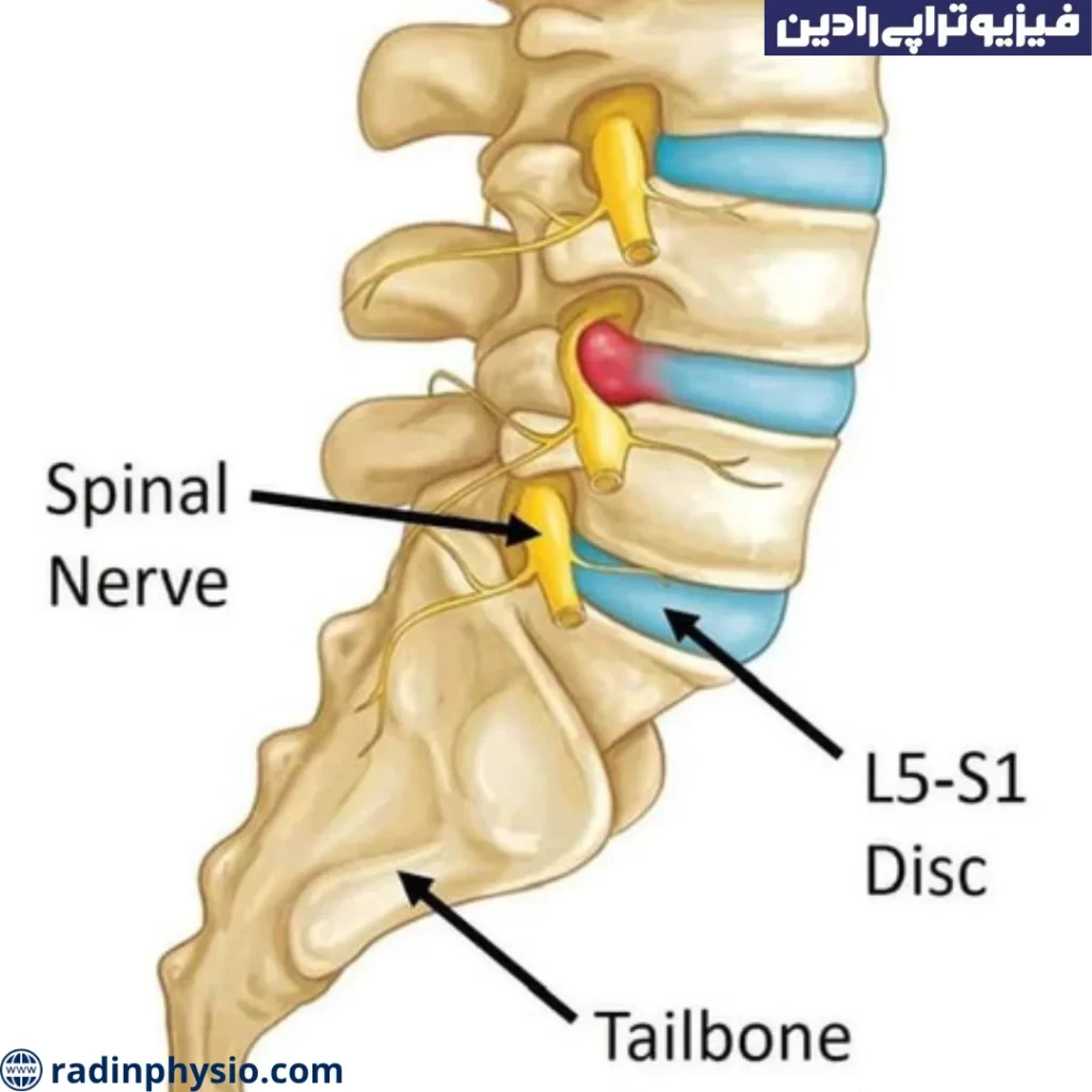 فیزیوتراپی علائم دیسک کمر در پاها