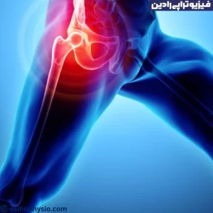 فیزیوتراپی دررفتگی مفصل لگن