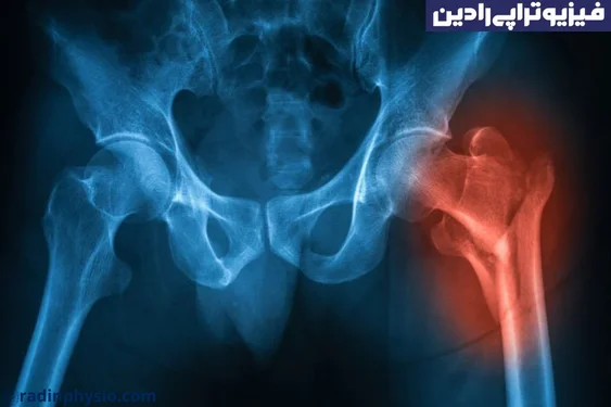 دررفتگی قابل بازگشت به عقب