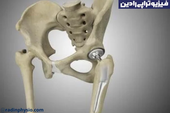 دررفتگی خلفی
