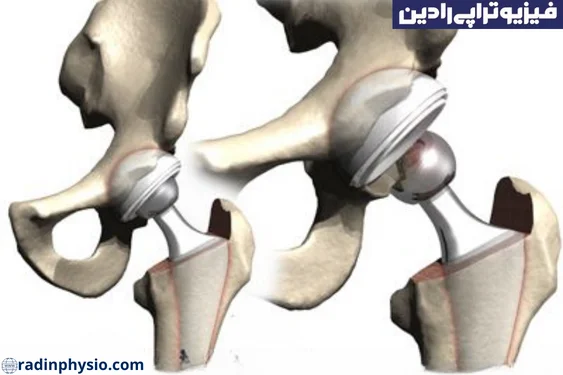دررفتگی غیرقابل بازگشت