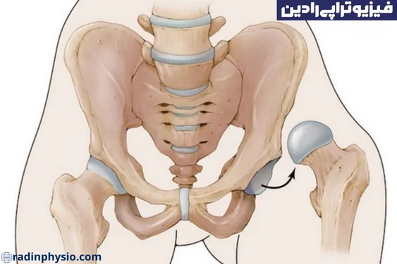 فیزیوتراپی در رفتگی لگن
