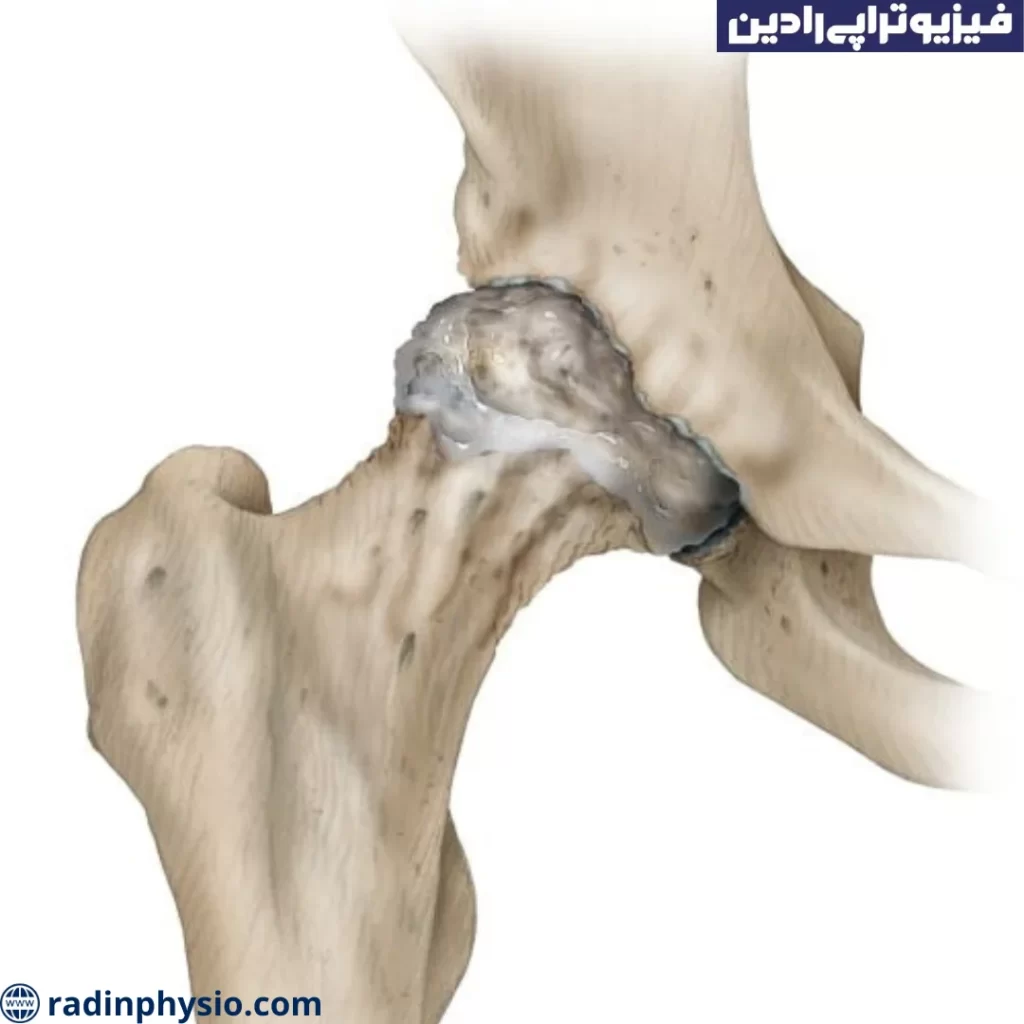 فیزیوتراپی در رفتگی مفصل لگن