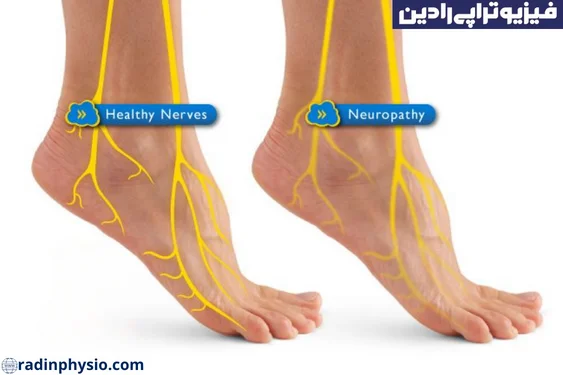 سندرم تونل تارس